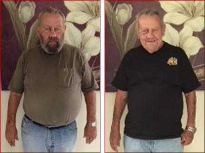 Patient before and after - Jim 60 lbs weight loss success