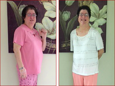 Patient before and after - Kathy 50 lbs weight loss success