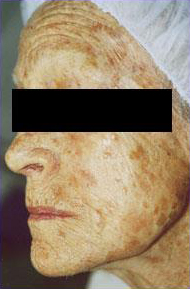 Erbium Laser Skin Resurfacing Patient 1 Before