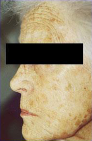 Erbium Laser Skin Resurfacing Patient 1 After