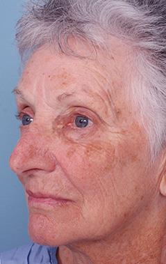 Erbium Laser Skin Resurfacing Patient 2 Before