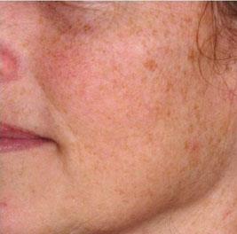 Erbium Laser Skin Resurfacing Patient 3 Before