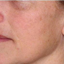 Erbium Laser Skin Resurfacing Patient 3 After