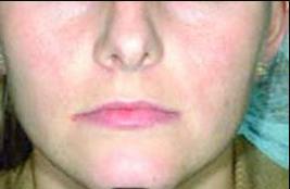 female after acne IPL treatment