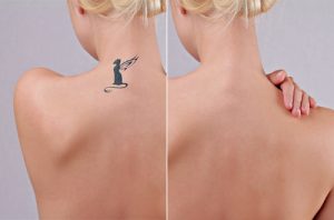 img-blog-Laser tattoo removal before and after
