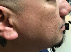 Microneedling Patient 1 After