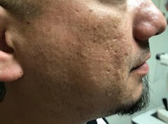 Microneedling before image.