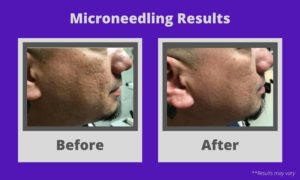  Before and after microneedling treatment preformed in Southern California.
