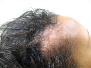 Hair Loss Systems Results after 1 treatment Patient 2 Before