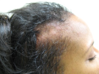 Hair Loss Systems Results after 1 treatment Patient 2 After