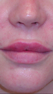 Lip augmentation fillers Patient 1 After