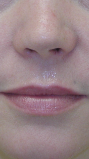 Lip augmentation fillers Patient 1 Before