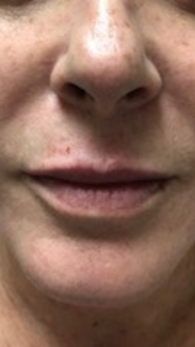 Lip augmentation fillers Patient 2 After