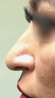 Nose job with fillers Patient 3 Before