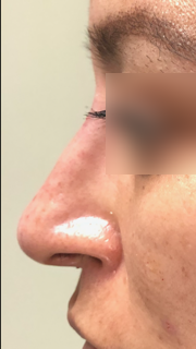 Nose job with fillers Patient 3 After