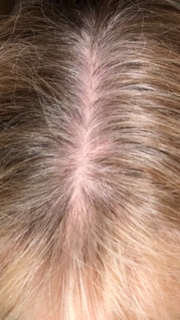 hair loss image