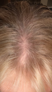 Hair Loss Systems Results after 2 treatments Patient 1 Before