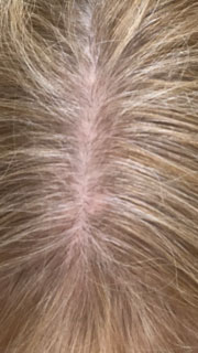 Hair Loss Systems Results after 2 treatments Patient 1 After