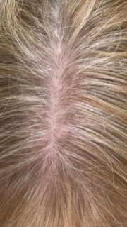 hair loss image