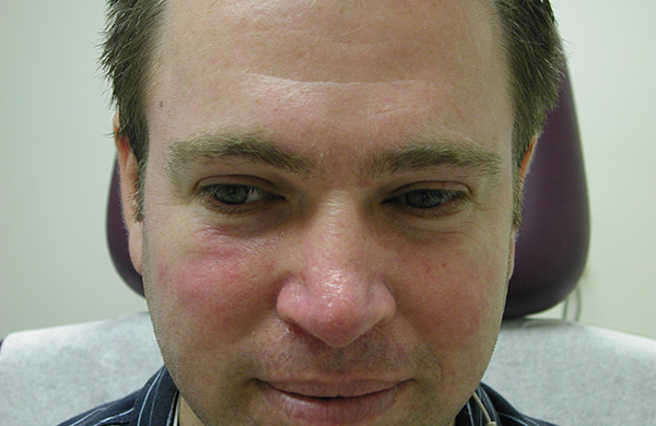 Spider vein treatment to the tip of the nose After