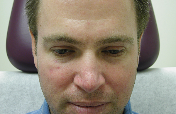 Spider vein treatment to the tip of the nose Before