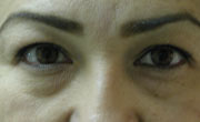 Lower eye lid bags removal Patient 1 Before