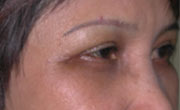 Upper eyelid lift Patient 1 After