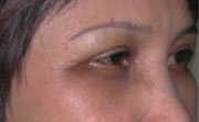 Upper Lid After Patient