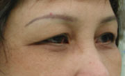 Upper eyelid lift Patient 1 Before