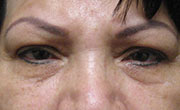 Lower eye lid bags removal Patient 2 Before