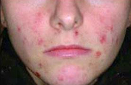 female before acne