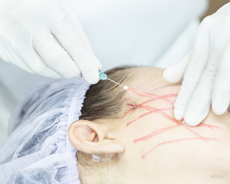 Women undergoing a thread lift with her cosmetic surgeon.