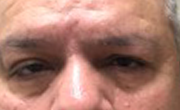 Upper Eyelid Lift  Patient 2 Before