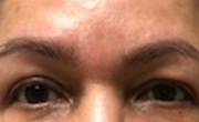 Upper Eyelid Lift Patient 3 After