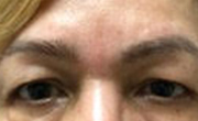 Upper Eyelid Lift Patient 3 Before