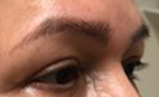 Upper Eyelid Lift Patient 5 After