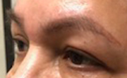 Upper Eyelid Lift Patient 4 After
