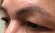 Upper Eyelid Lift Patient 4 Before